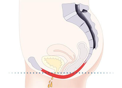 Pelvic-Floor Muscle Repair 5 Pelvic floor muscles Rowley Regis