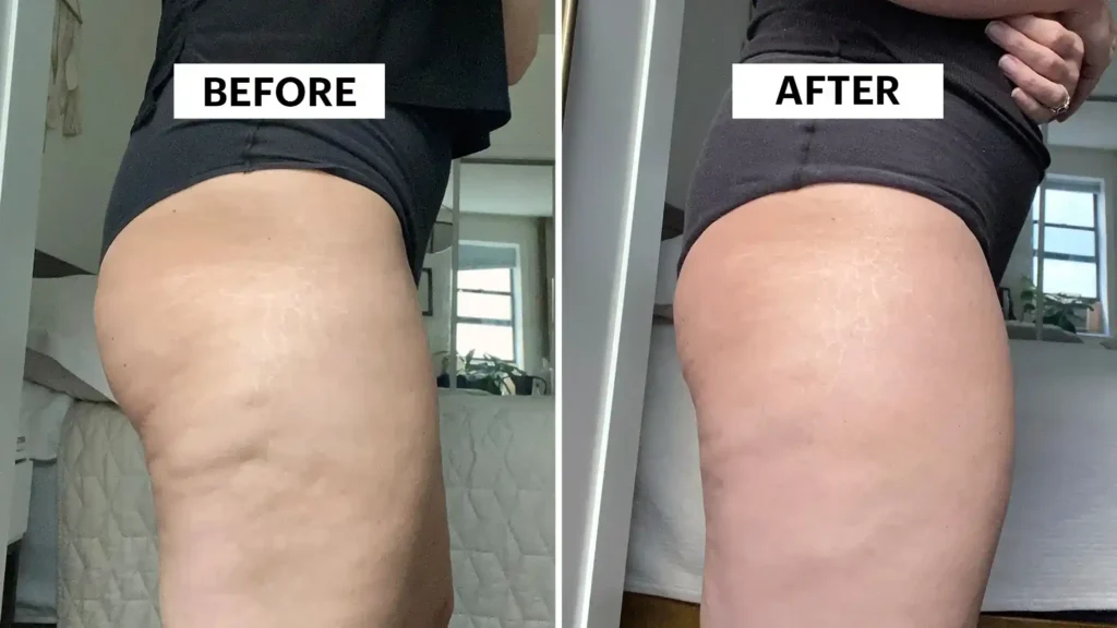 Sculpting Your Bum: Can Toning Exercises Really Reduce Cellulite? 1 Do Toning Exercise Rowley Regis Really Tackle Cellulite?