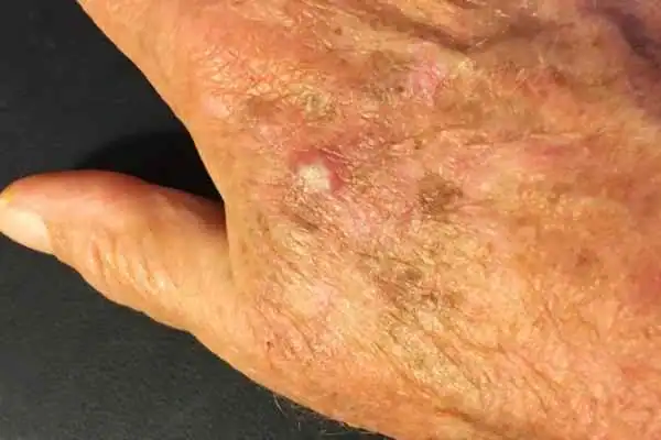 Cryopen For Actinic Keratoses 1 Image of Actinic keratoses Rowley Regis on a person hand