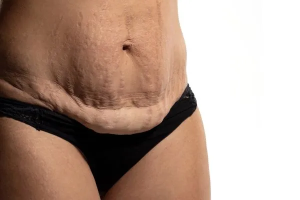 The Science of Skin Tightening 1 The science behind skin tightening Rowley Regis picture of a woman's sagging skin on the stomach